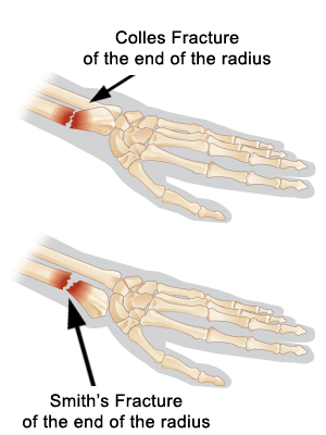 colles fracture smith fracture colles fracture smith fracture